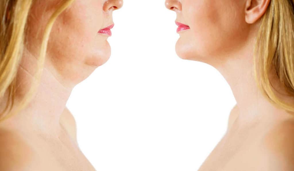 Double Chin treatment Stoke-on-Trent before and after results