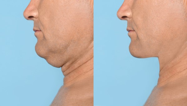 Which Non-Surgical Treatments Work Best for Jowls and Loose Skin Stoke-on-Trent?