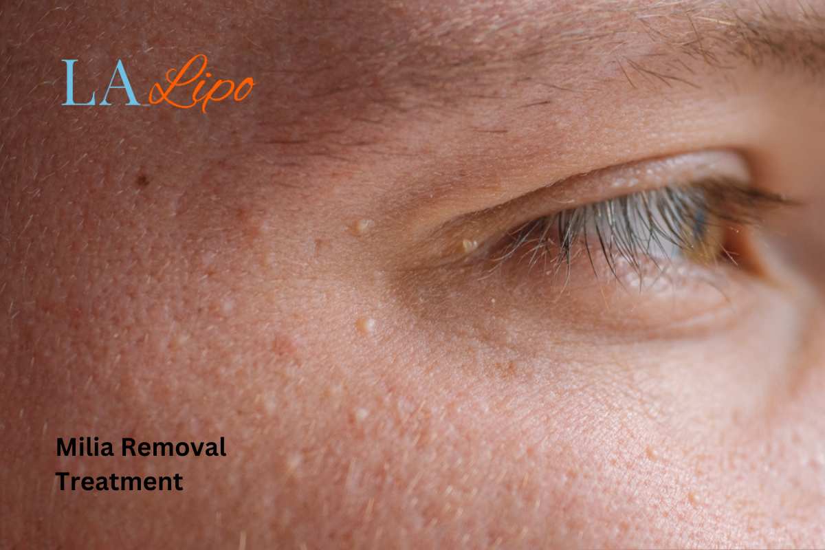 Cryopen Milia Removal: Is It the Easiest and Safest Option Stoke-on-Trent?