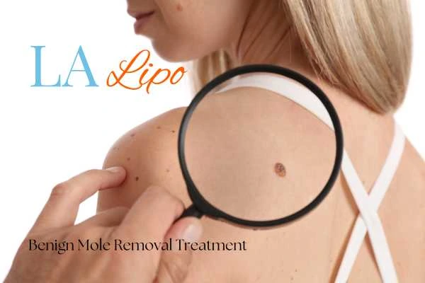 Woman having her inspection of blemish before mole removal Stoke-on-Trent