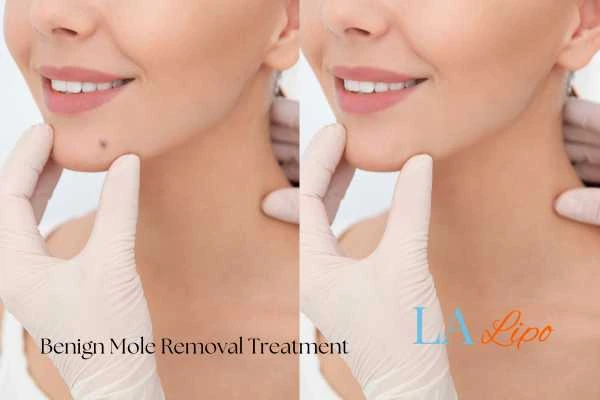 Before and after mole removal Stoke-on-Trent treatment