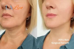 hi-fu for wrinkles Stoke-on-Trent before and after results