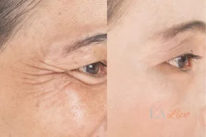 Before and after results of woman - HI-fu wrinkles reduction treatment Stoke-on-Trent