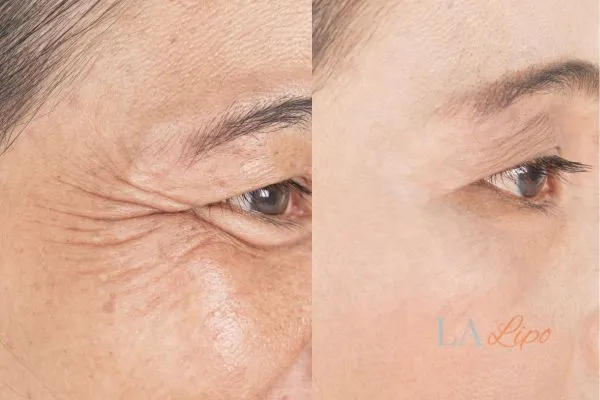 Before and after results of woman - HI-fu wrinkles reduction treatment Stoke-on-Trent