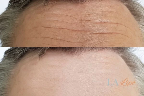 results of HIFU Stoke-on-Trent on mans forehead to help reduce lines and wrinkles