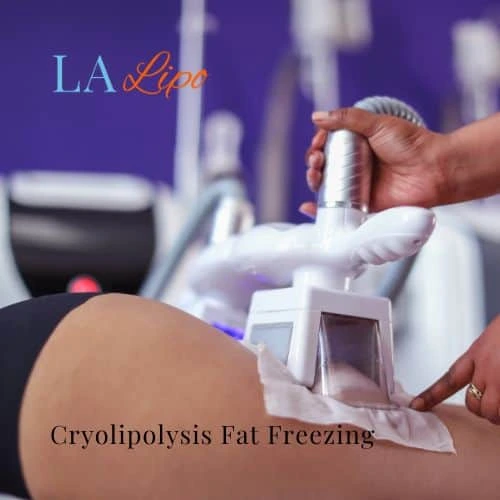 fat freezing - Cryolipolysis Stoke-on-Trent