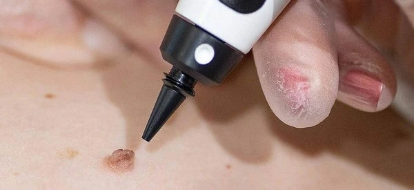 skin tag removal using cryopen Stoke-on-Trent