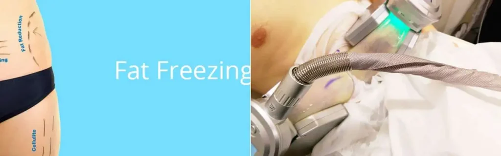 Fat freezing Stoke-on-Trent on multiple areas of the body