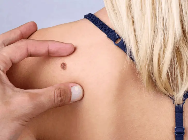 woman having mole removal Stoke-on-Trent consultation before treatment.
