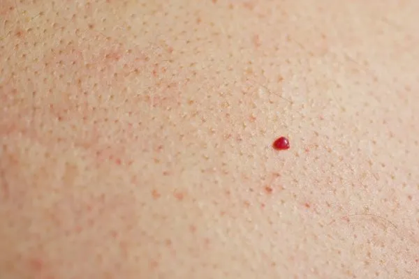 close up of a cherry angioma Stoke-on-Trent