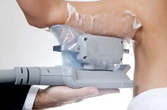 Picture of fat freezing Stoke-on-Trent on the upper arms.