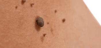image of a skin tag Stoke-on-Trent