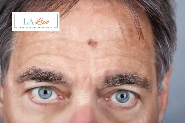 Solar Lentigo Removal Stoke-on-Trent image of man with mark on his forehead