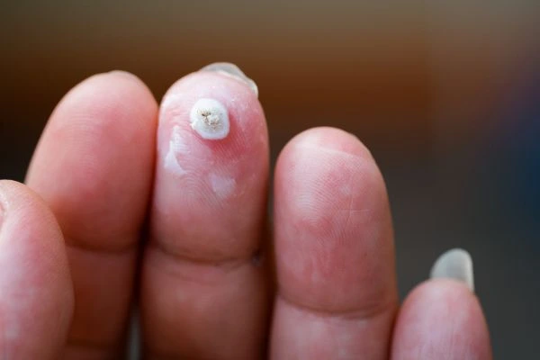 wart on person finger - cryotherapy to treat from LA LIPO Stoke-on-Trent