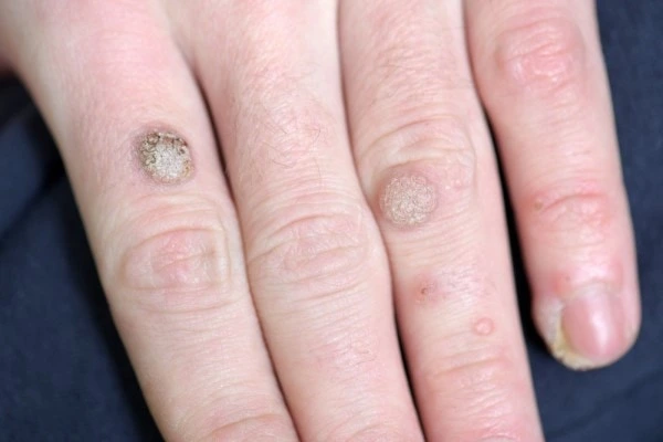 photo of warts on person hand - see wart removal Stoke-on-Trent from LA LIPO