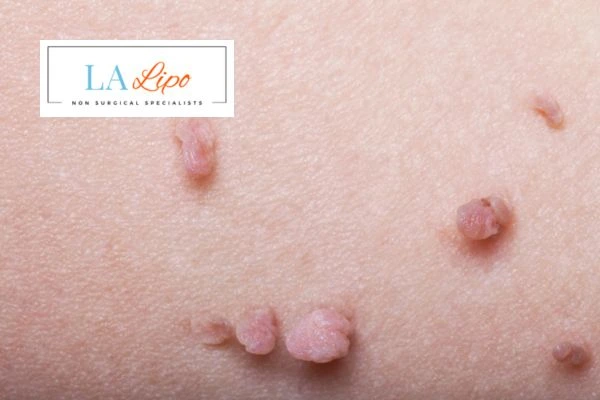 Does cryopen skin tag removal Stoke-on-Trent hurt? Find out now call our team today!