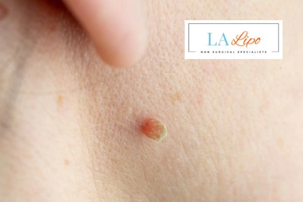 Book skin tag removal Stoke-on-Trent today speak to our team now!
