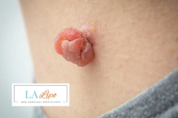 Interested in skin tag removal Stoke-on-Trent? Concerned about the pain? Find out more today!