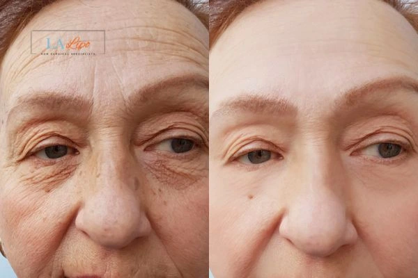 The powerful benefits of Morpheus8 Treatment Stoke-on-Trent - Call Our team today!