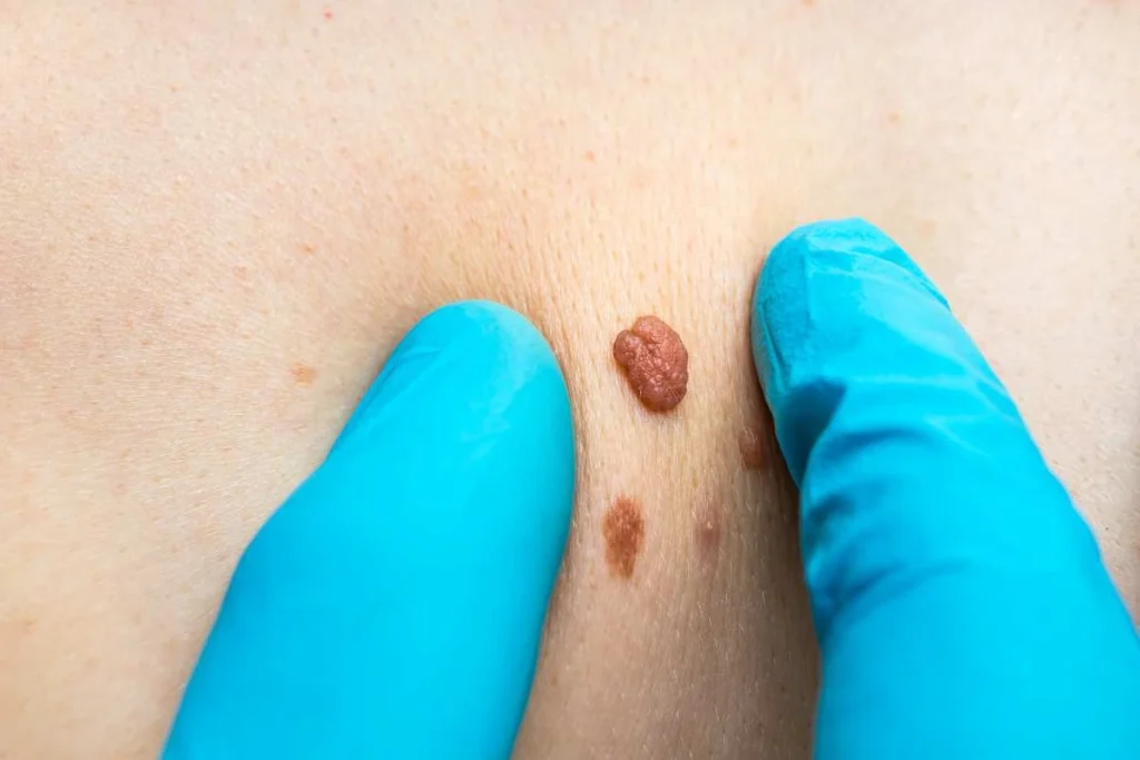 LA LIPO Cryopen Lesion Removal Prices Stoke-on-Trent