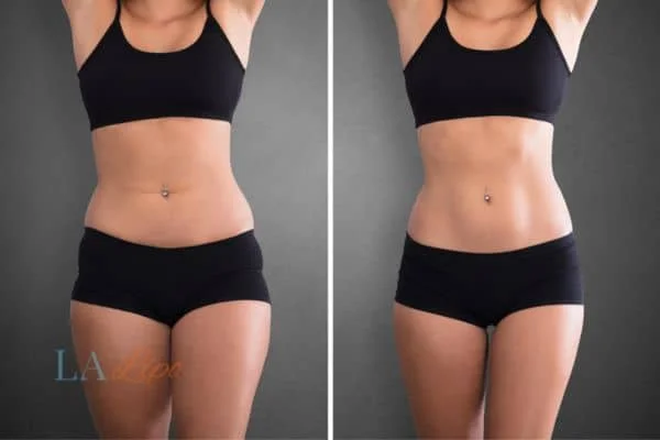 before and after results of non-surgical treatment to help a woman's body image and mental health Stoke-on-Trent