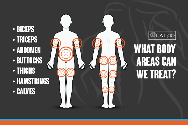 Diagram to show areas you can have LA-EMS Body Sculpting Treatment Stoke-on-Trent