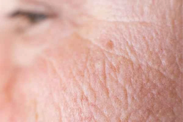 close up picture of a woman's face showing an age spot Stoke-on-Trent