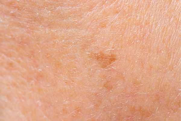 close up picture of age spots Stoke-on-Trent
