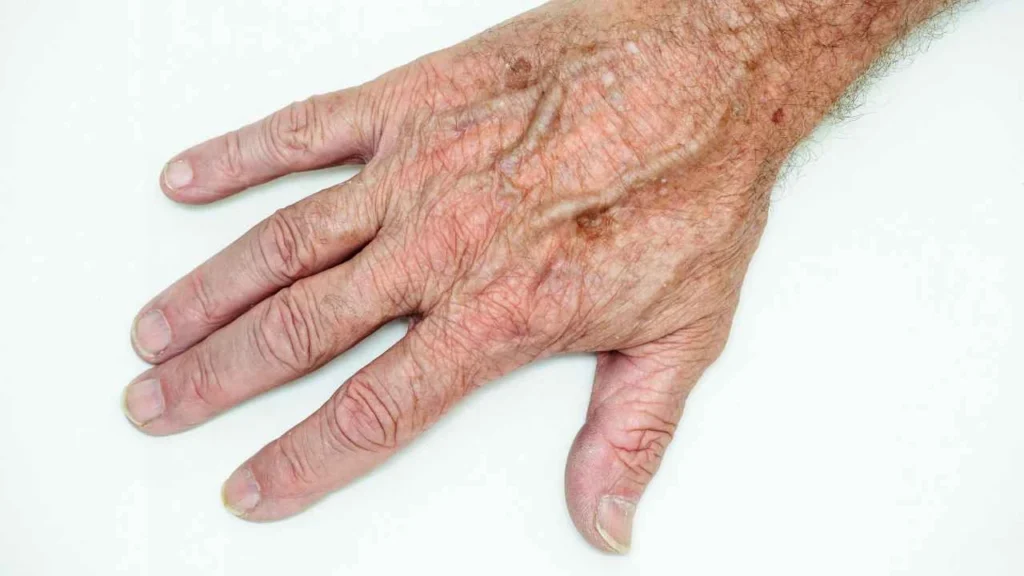 Male hand showing age spot Stoke-on-Trent