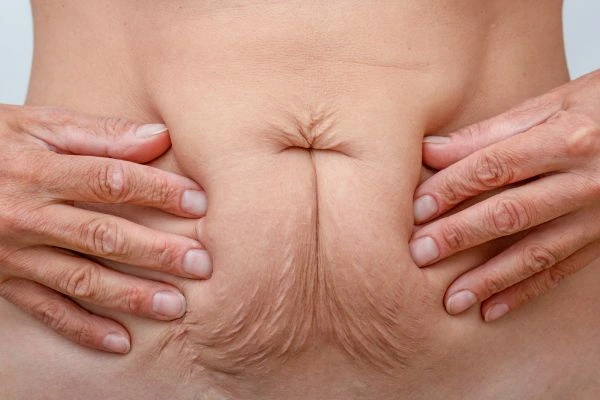 Image of a woman's stomach with loose skin - example of skin tightening Stoke-on-Trent options