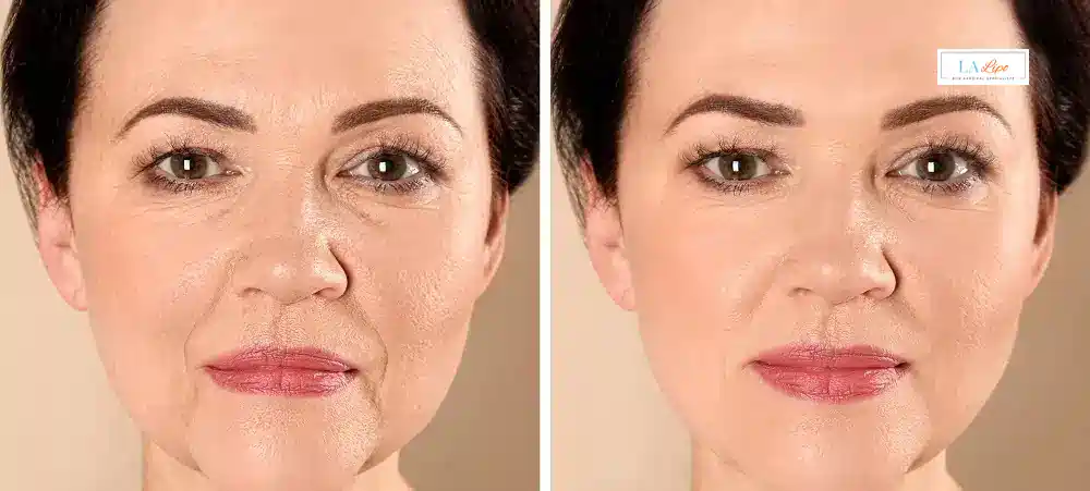 How Long Does It Take to See Results and How Long Do They Last Stoke-on-Trent?