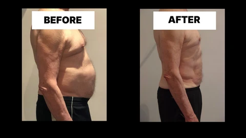 What Symptoms Can Diastasis Recti Cause in Men? Weak Core, Back Pain and Poor Posture Stoke-on-Trent